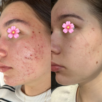 Фото из портфолио косметолога Руслана Хворостенко (Черкассы)