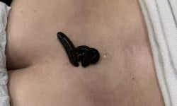 Гирудотерапия Реабілітолог  Одеса