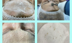 Чистка обличчя Майстер з пірсингу Татьяна Київ