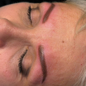 Одразу після процедури. 
У жінки дуже чутлива шкіра.