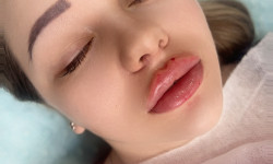 Збільшення губ Косметолог-ін'єкціоніст Наталья Дніпро