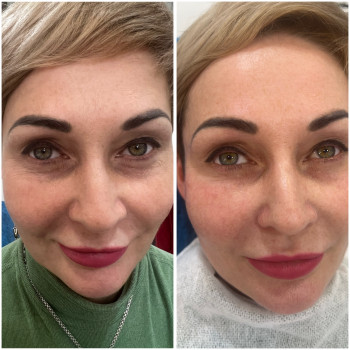 Корекція зони під очима