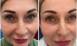 Корекція носослізноі борозни Косметолог-инъекционист Наталья Днепр