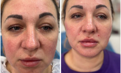 Корекция средней трети лица Косметолог-ін'єкціоніст Наталья Дніпро