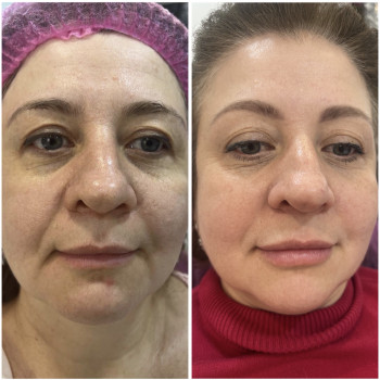 Подтяжки лица нитями с насечками Cog, Molding
                    Косметолог-инъекционист Наталья Днепр