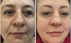 Подтяжки лица нитями с насечками Cog, Molding Косметолог-ін'єкціоніст Наталья Дніпро