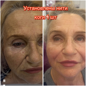 Подтяжки лица нитями с насечками Cog, Molding
                    Косметолог-инъекционист Наталья Днепр