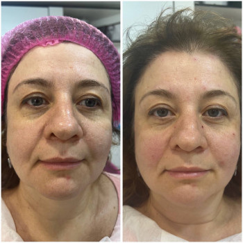 Подтяжки лица нитями с насечками Cog, Molding
                    Косметолог-инъекционист Наталья Днепр