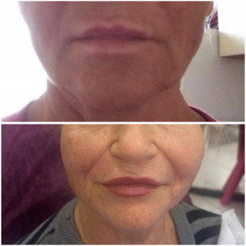 Подтяжки лица нитями с насечками Cog, Molding
                    Косметолог-инъекционист Наталья Днепр