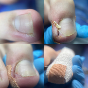 Врослі нігті