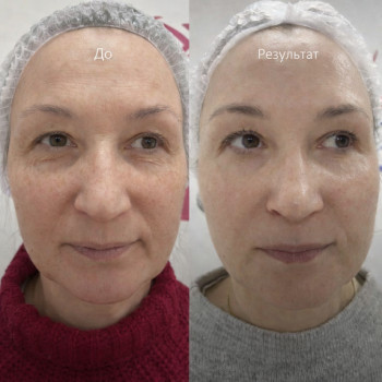 RF-ліфтинг після 5 процедур