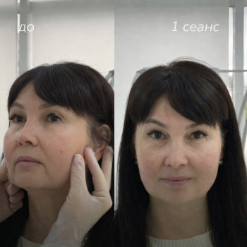 RF-ліфтинг плюс карбоксітерапія після 1 сеансу