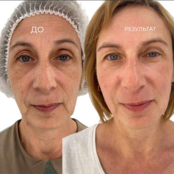 Електропорація після пройденого курсу 10 процедур