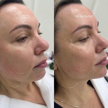 УЗ ліфтінг після пройденого курсу 8 процедур