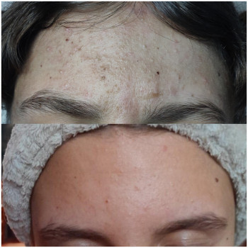 Лікування проблемної шкіри