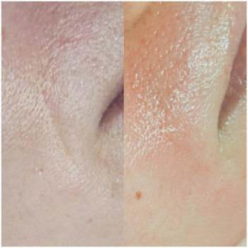 Екзосомальна терапія.