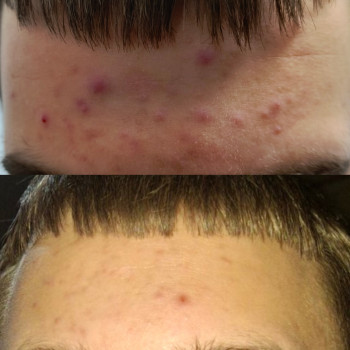 Лікування проблемної шкіри