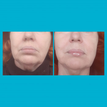  #мікронідлинг #екзосомиодесса
Результат применения єкзосом после первой процедуры.65 лет