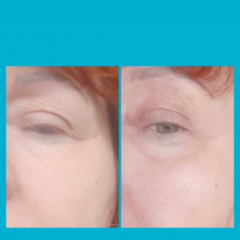  
 
Проработка нависшего века:до и сразу после процедуры