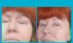 Exosome lift-Экзосомы(микронидллинг) Косметолог-естетист Ирина Валерьевна Одеса