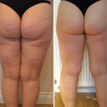 Вакуумний масаж після 8 процедур