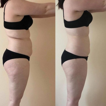 Вакуумний масаж після 5 процедур