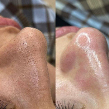 Чистка обличчя