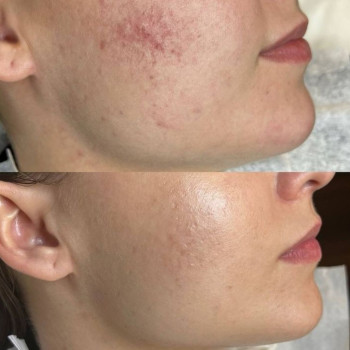 Програма для проблемної порістої шкіри