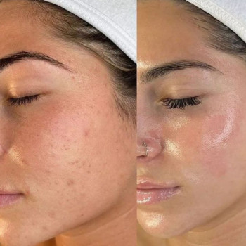 Чистка для проблемної шкіри