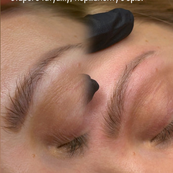 Видалення татуажу брів ремувером.