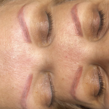 Видалення татуажу брів ремувером.