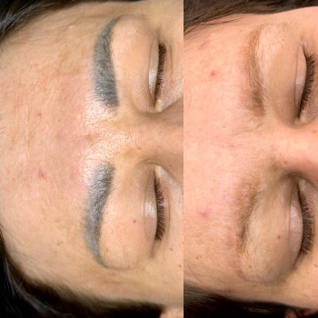 4 видалення лазером