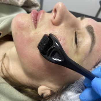 Пілінг під мезороллер чудова процедура оновлення., фото - майстер перманентного макіяжу Ольга Новікова