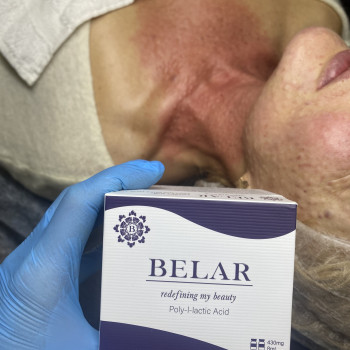 Полімолочна кислота-потужний колагеностимулятор для шкіри., фото - майстер перманентного макіяжу Ольга Новікова