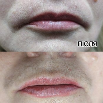  #електроепіляція #електроепіляціяжитомир #епіляція #епіляціяжитомир