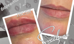 Promoitalia SkinFill Bacio (від 0,5 мл) — зволоження та природний об’єм губ Косметолог Светлана Харків