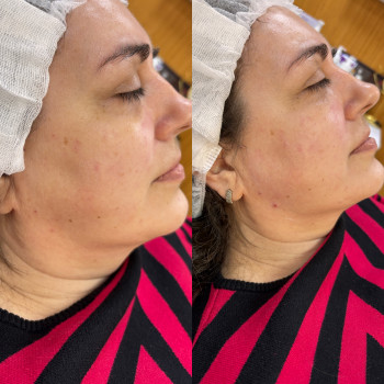 Фото из портфолио косметолога Любов Чумаченко (Запорожье)