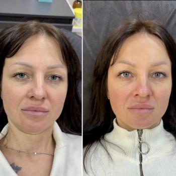 Фото из портфолио косметолога Любов Чумаченко (Запорожье)