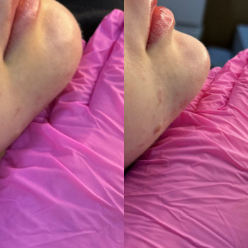 Фото из портфолио косметолога Любов Чумаченко (Запорожье)