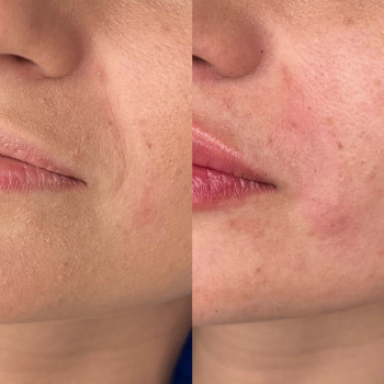 Фото из портфолио косметолога Любов Чумаченко (Запорожье)