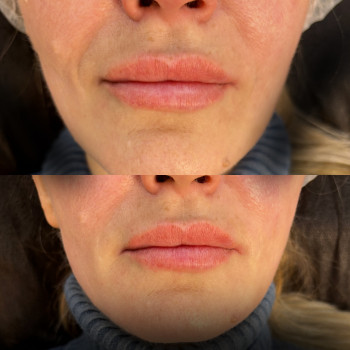 Фото из портфолио косметолога Любов Чумаченко (Запорожье)