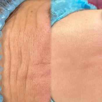 Ботулинотерапия зоны лба, фото - мастер перманентного макияжа Інна Лебедь