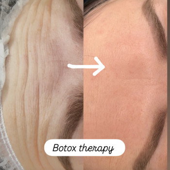 Ботулинотерапия лоб, фото - мастер перманентного макияжа Інна Лебедь