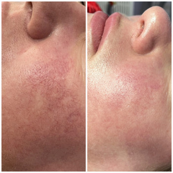 Лікування куперозу