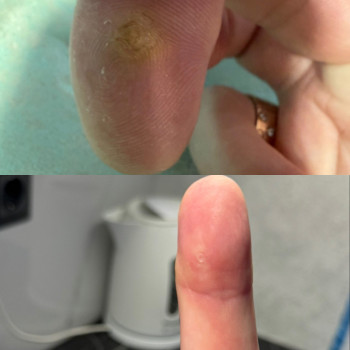 Видалення бородавок, фото - косметолог Ольга Мельник