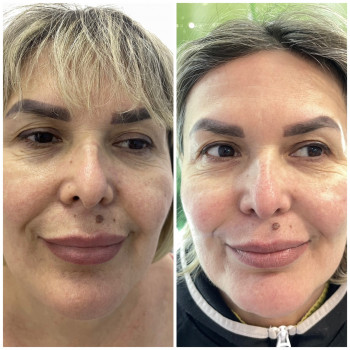 Мікроголковий RF