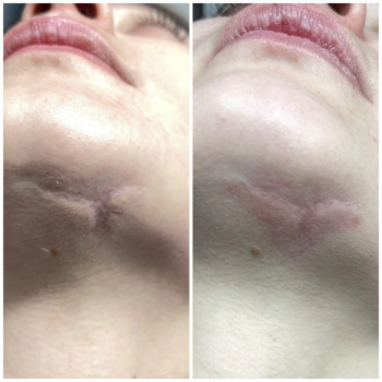 Шліфування шраму в поєднанні з інʼєкцієми, фото - косметолог Ольга Мельник