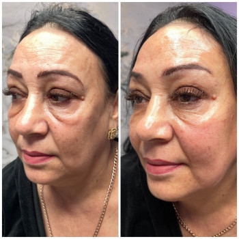 Омолодження, фото - косметолог Ольга Мельник