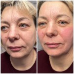 Smooth + мезотерапія Косметолог Оля Белая Церковь