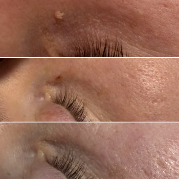 Видалення новоутворень